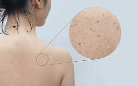 8 Mẹo Chăm Sóc Da Mụn Đầu Đen Ở Lưng Đúng Chuẩn