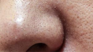 Top 4 Mẹo Chăm sóc da sợi bã nhờn vô cùng hiệu quả